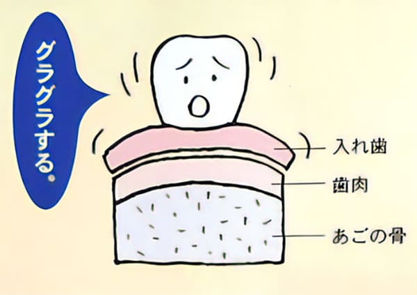 ふつうの入れ歯の場合